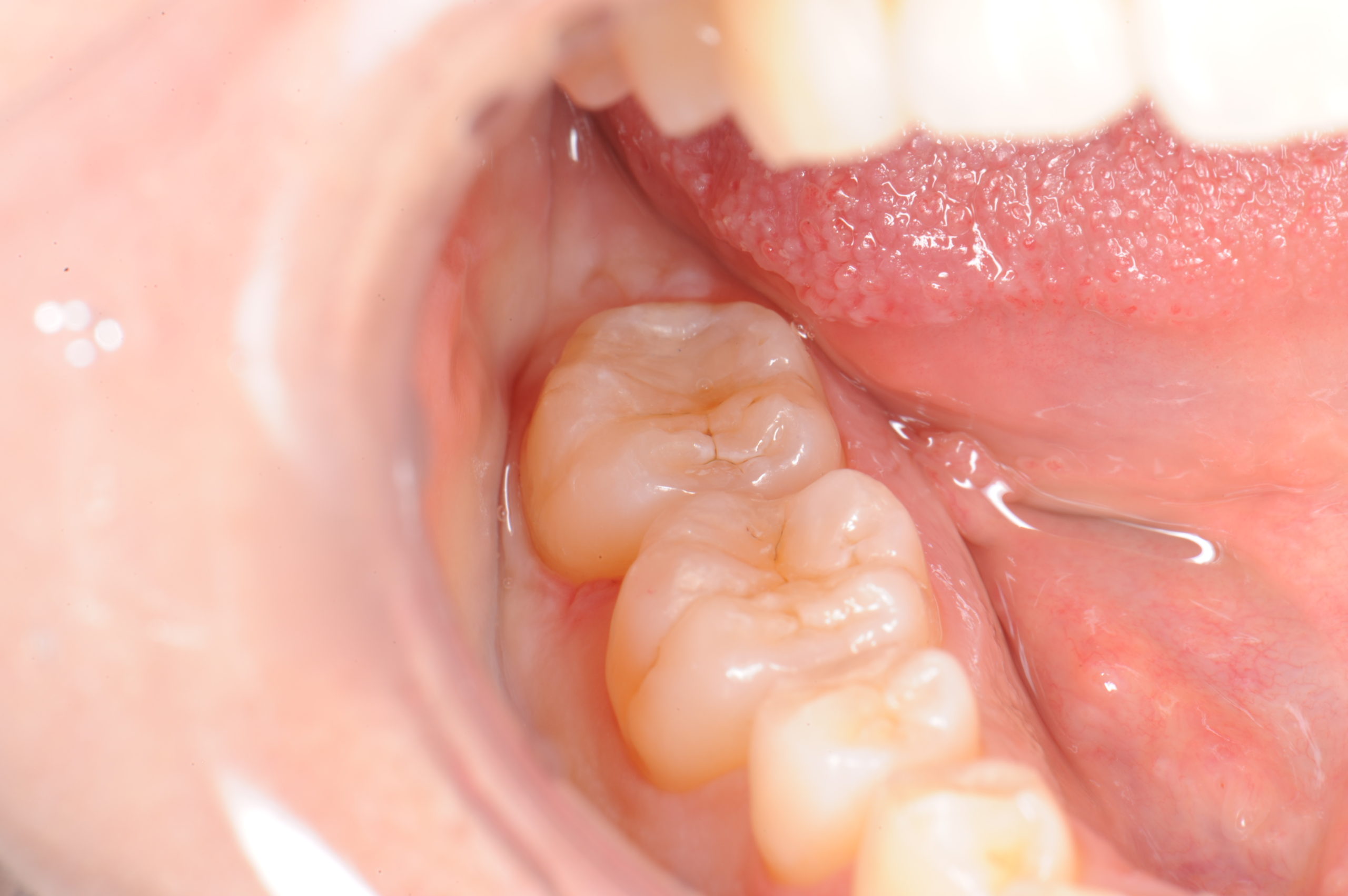 セルフケアと予防